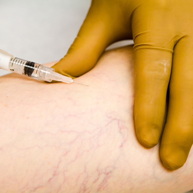 needle in vein