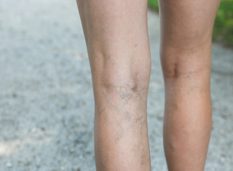Painful Varicose And Spider Veins On Woman Legs in Houston, TX