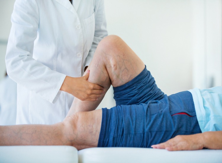 Effective Varicose Vein Therapy in Houston, TX