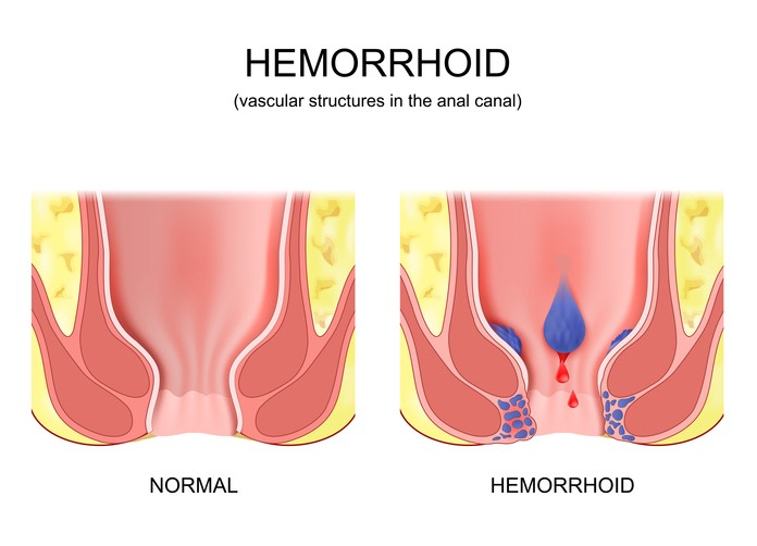 Hemorrhoidal Disease Hemorrhoidal Disease Treatment Options in Houston, TX