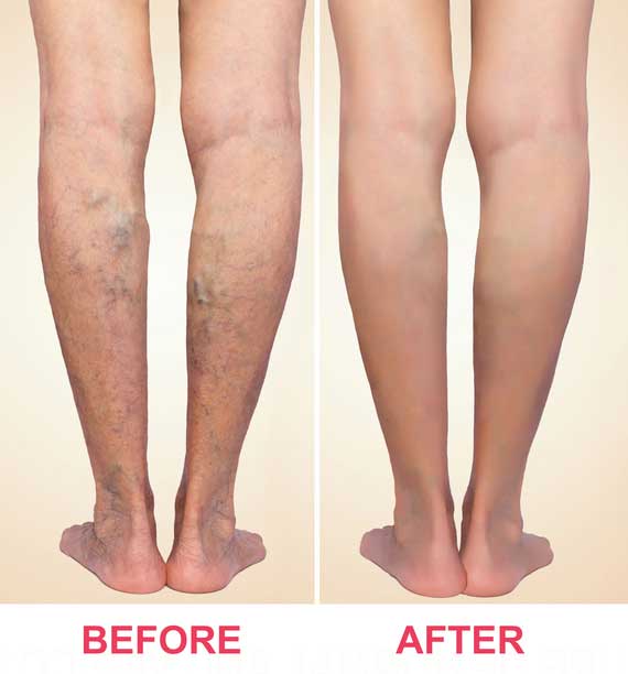 Before & After Varicose Vein Treatment in Houston, TX